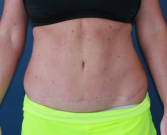 Feel Beautiful - Best Tummy Tuck 38 - After Photo